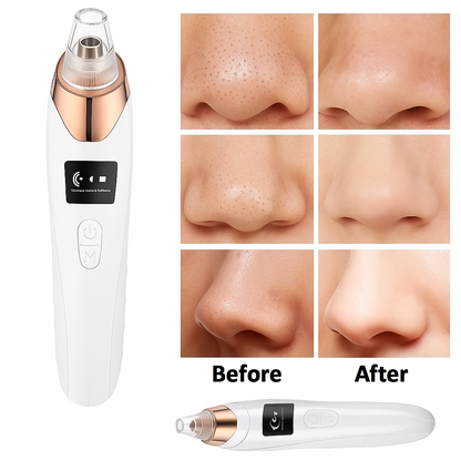 UBA™ – Electric Acne Pore Cleaner &amp; Blackhead Remover